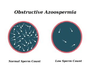 Obstructive Azoospermia